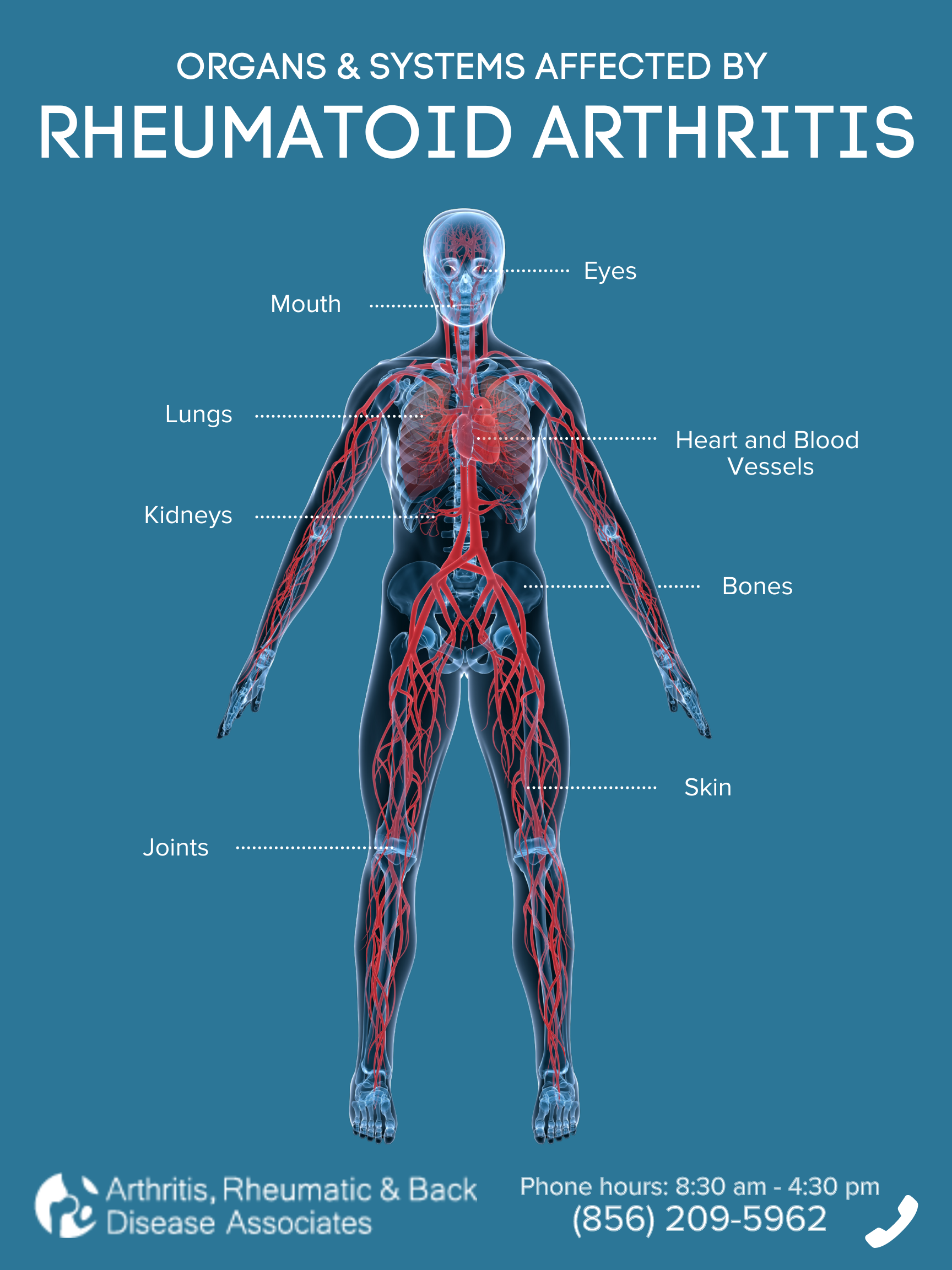 residual-symptoms-in-patients-with-rheumatoid-arthritis-arthritis