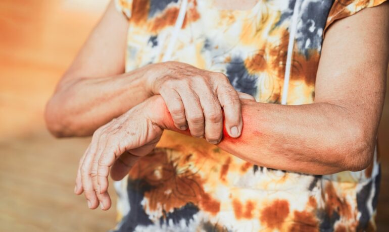 Senior woman holding her painful wrist due to psoriatic arthritis flare-up.